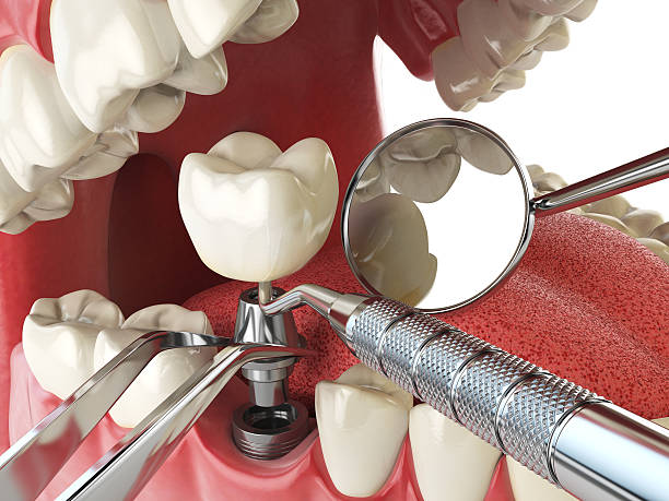 Best Emergency Treatment for Dental Infections or Abscesses in Grand Point, LA